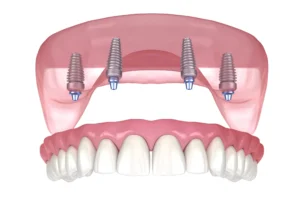 all-on-4-dental-implants eat normal food