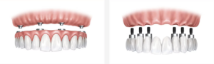 all on 4 implants different from traditional dental implants