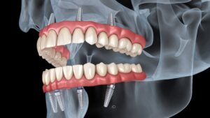 all on 4 implant candidate