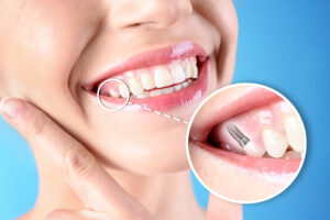 how long do dental implants last