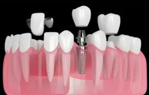 what is a dental implant restoration