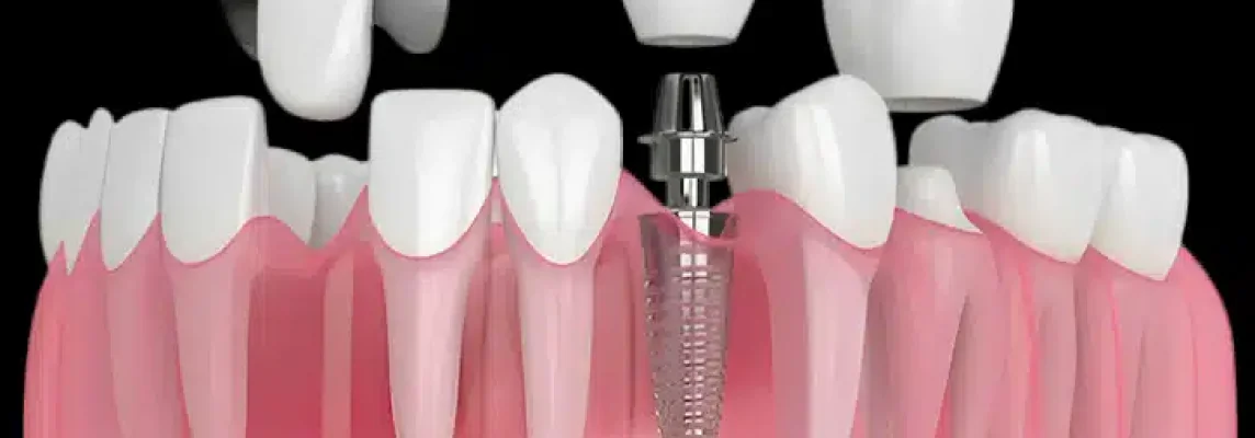 what is a dental implant restoration